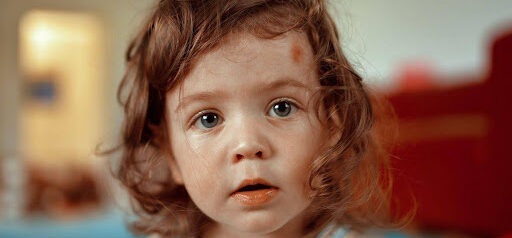 young girl has a red mark on her forehead KHM Attorneys at Law Colorado Springs, Castle Rock